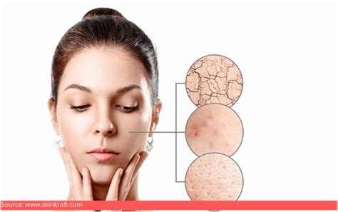 How to Protect Your Skin Naturally During Seasonal Changes
