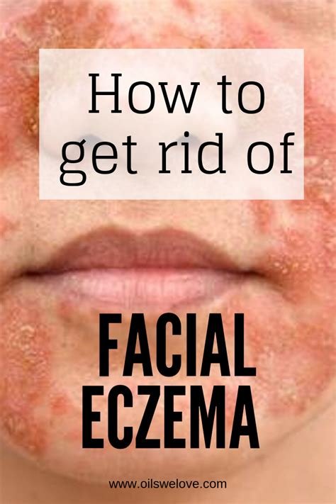 Natural Remedies for Common Skin Issues: Acne, Eczema, and More